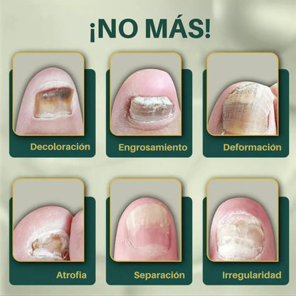 Serum Para Hongos - Uñas con mejor aspecto en 7 días con uso diario 100% NATURAL